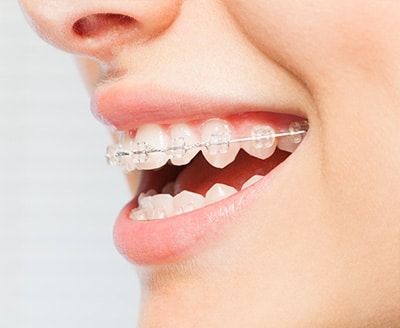 Ceramic braces treatment option for discreet teeth alignment at Dr. B Smiles Orthodontics in Wappingers Falls, NY