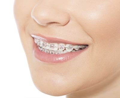 Metal braces treatment option for teeth alignment at Dr. B Smiles Orthodontics in Wappingers Falls, NY