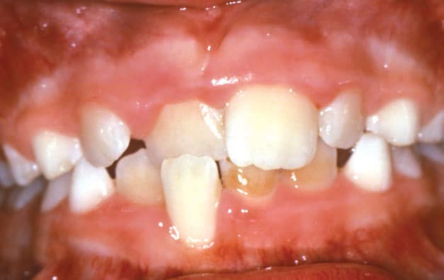 Crossbite orthodontic condition affecting tooth alignment treated at Dr. B Smiles Orthodontics in Wappingers Falls, NY