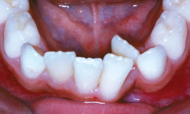 Spacing orthodontic condition with gaps between teeth treated at Dr. B Smiles Orthodontics in Wappingers Falls, NY