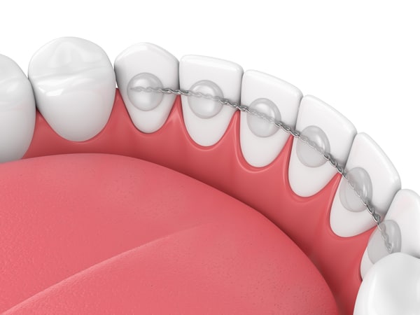 Fixed bonded wire retainer placed behind teeth at Dr. B Smiles Orthodontics in Wappingers Falls, NY