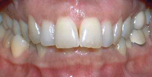 Overbite orthodontic condition affecting bite alignment treated at Dr. B Smiles Orthodontics in Wappingers Falls, NY