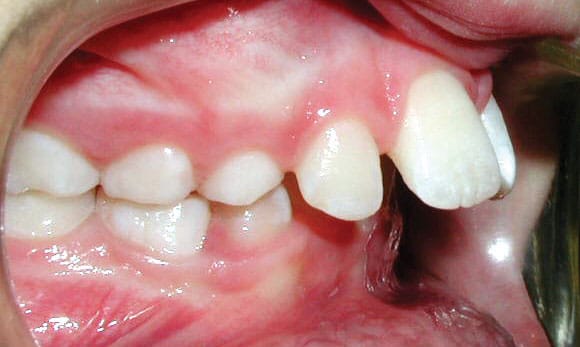 Upper front teeth protrusion orthodontic condition treated at Dr. B Smiles Orthodontics in Wappingers Falls, NY