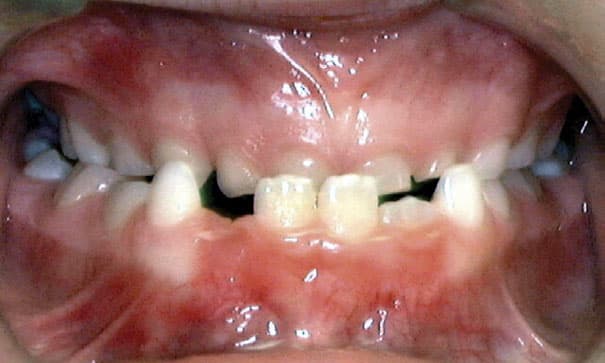 Underbite orthodontic condition affecting jaw alignment treated at Dr. B Smiles Orthodontics in Wappingers Falls, NY